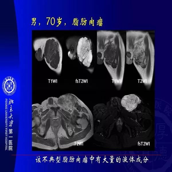 【PPT】MRI诊断软组织肿瘤研究思考
