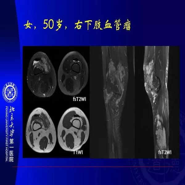 【PPT】MRI诊断软组织肿瘤研究思考