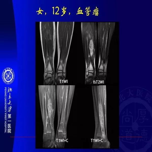【PPT】MRI诊断软组织肿瘤研究思考