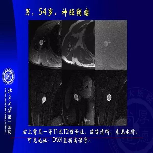 【PPT】MRI诊断软组织肿瘤研究思考