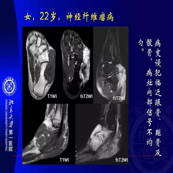 【PPT】MRI诊断软组织肿瘤研究思考