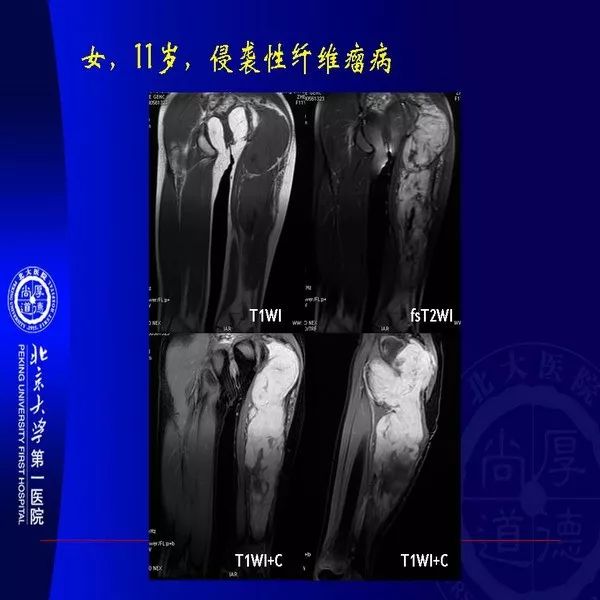【PPT】MRI诊断软组织肿瘤研究思考