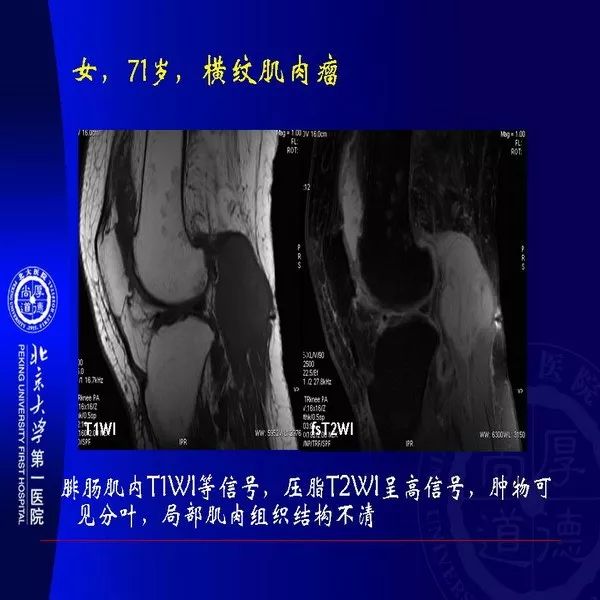【PPT】MRI诊断软组织肿瘤研究思考