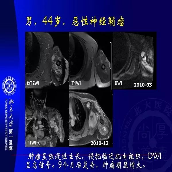 【PPT】MRI诊断软组织肿瘤研究思考