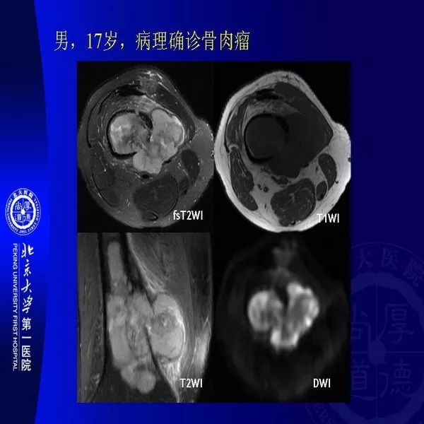 【PPT】MRI诊断软组织肿瘤研究思考