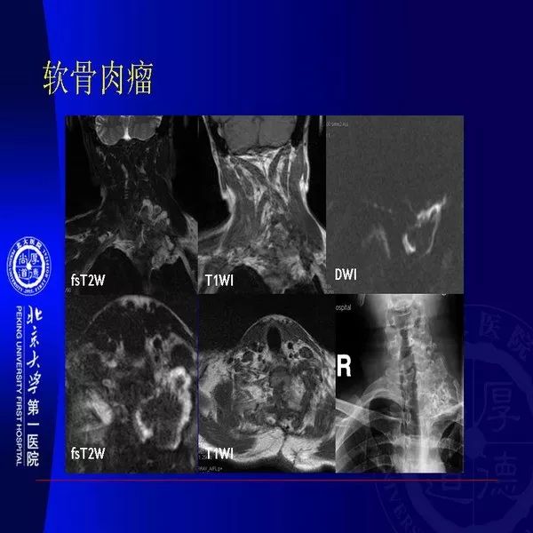 【PPT】MRI诊断软组织肿瘤研究思考