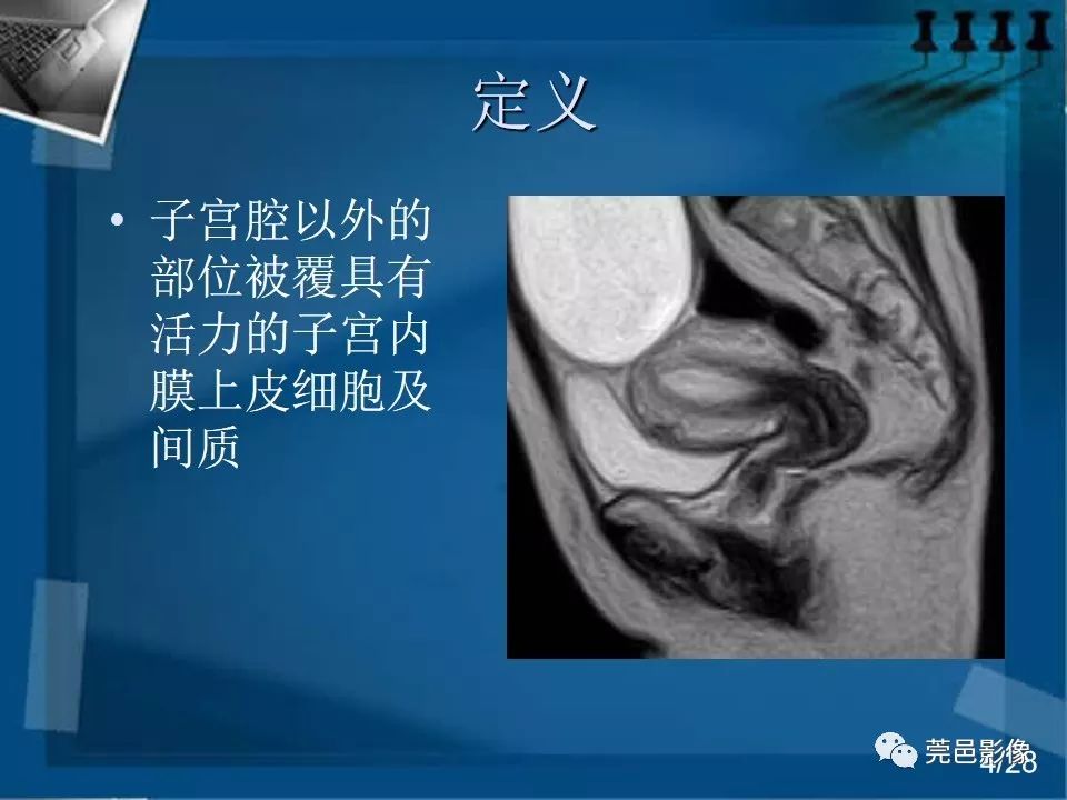【PPT】子宫内膜异位症MRI诊断