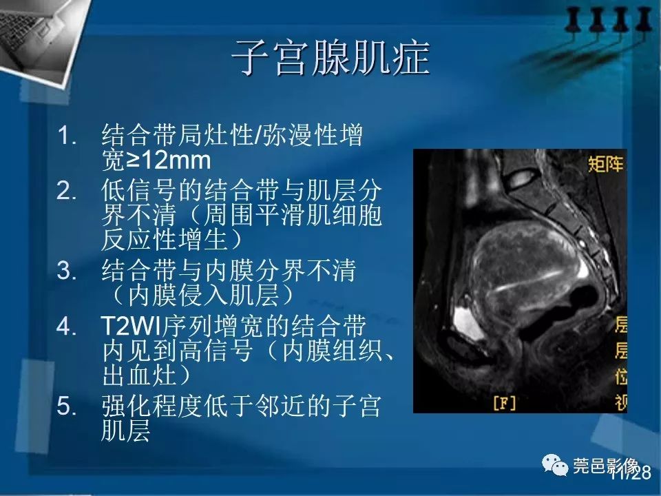【PPT】子宫内膜异位症MRI诊断