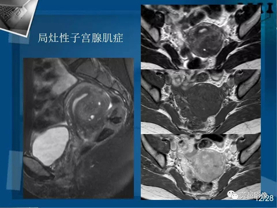 【PPT】子宫内膜异位症MRI诊断