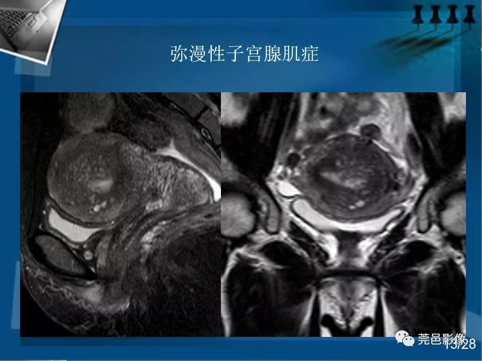 【PPT】子宫内膜异位症MRI诊断