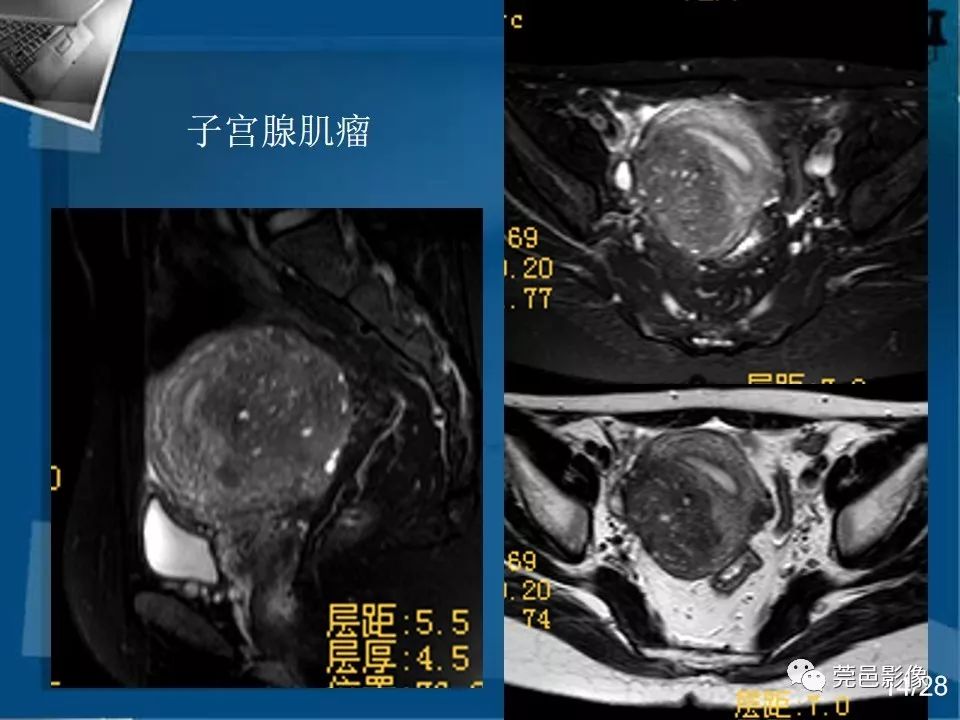 【PPT】子宫内膜异位症MRI诊断