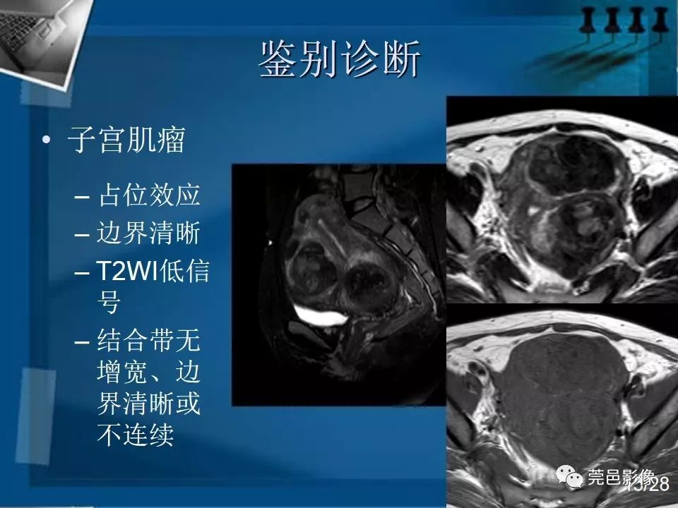 【PPT】子宫内膜异位症MRI诊断