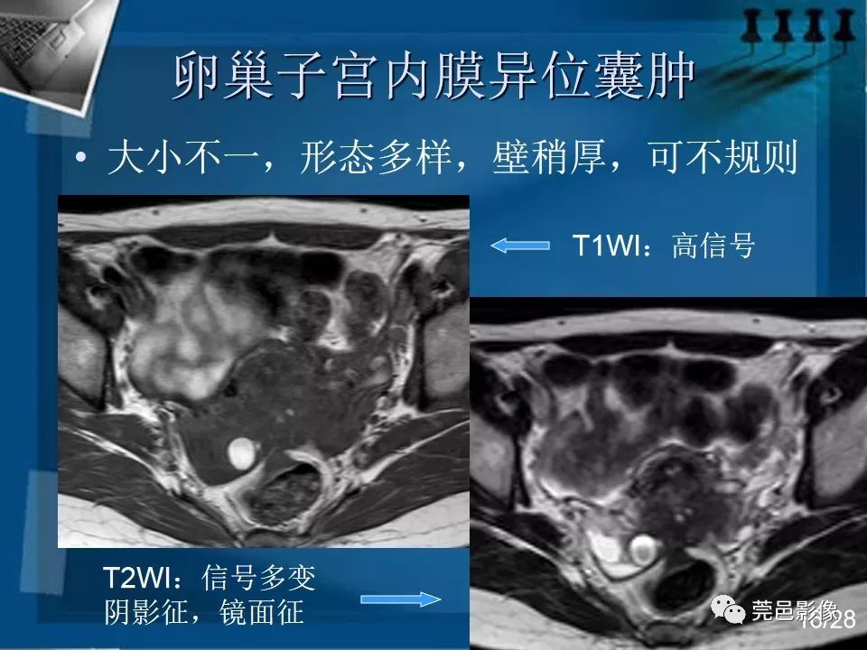 【PPT】子宫内膜异位症MRI诊断
