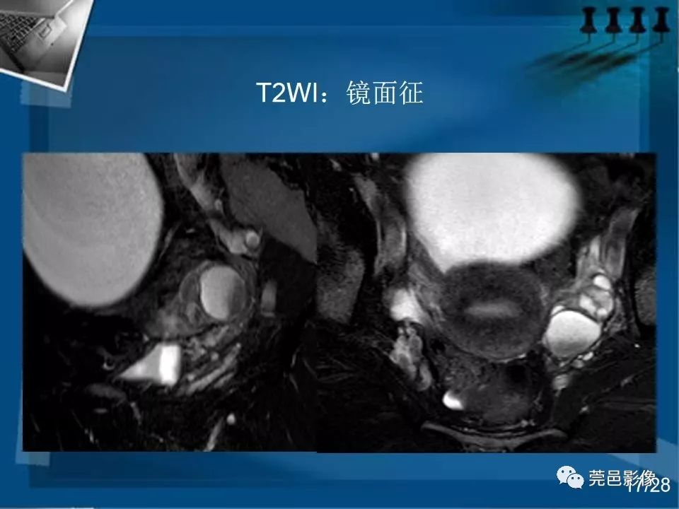 【PPT】子宫内膜异位症MRI诊断