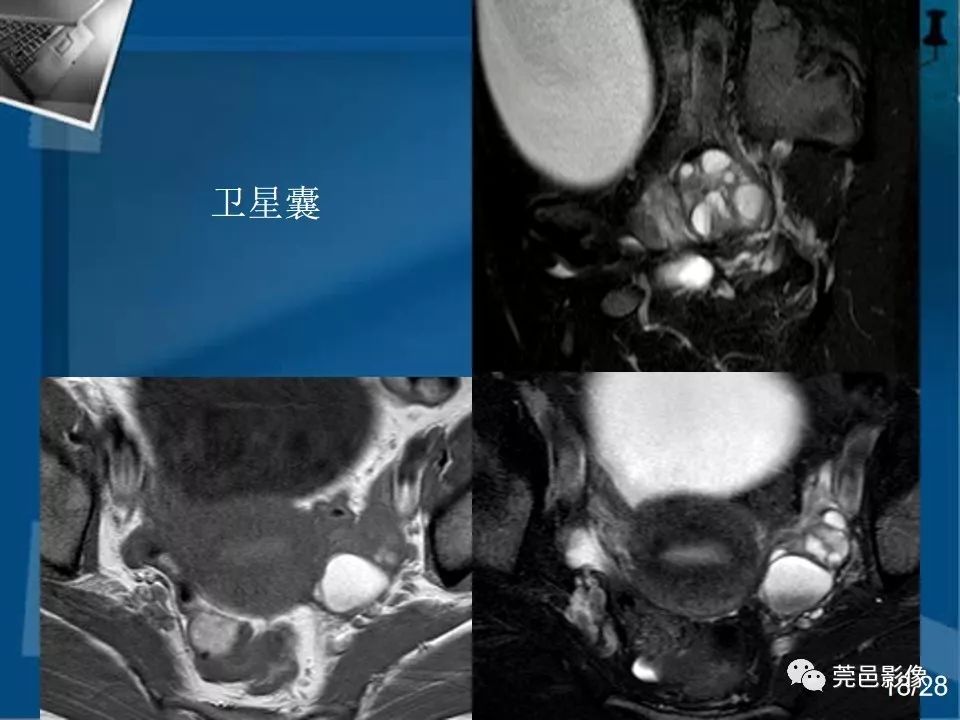 【PPT】子宫内膜异位症MRI诊断