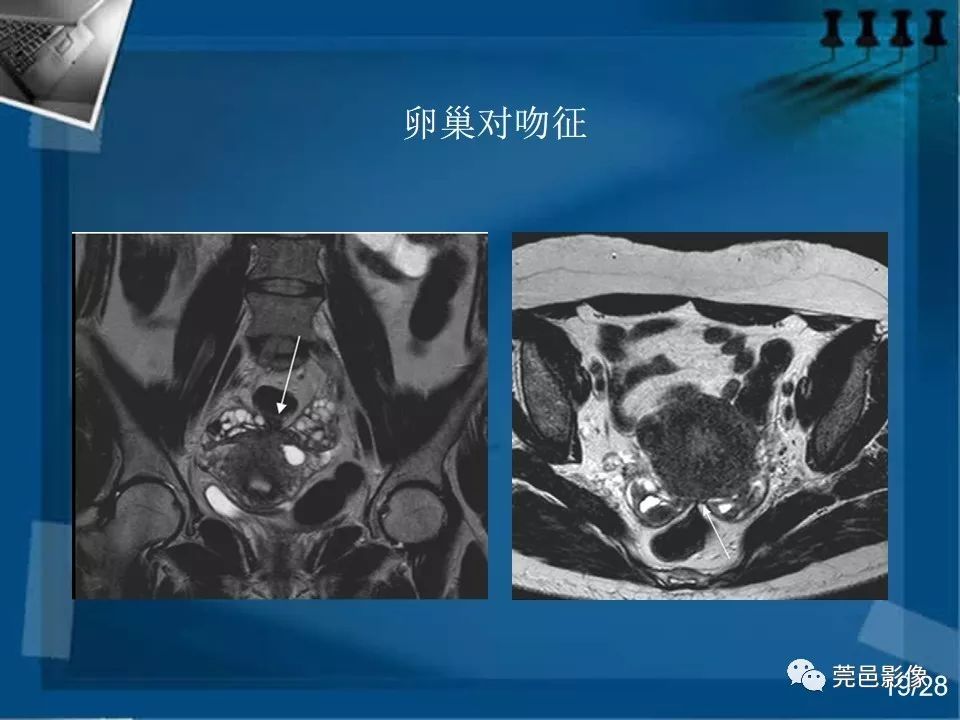 【PPT】子宫内膜异位症MRI诊断