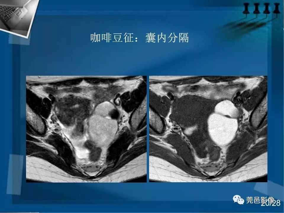 【PPT】子宫内膜异位症MRI诊断