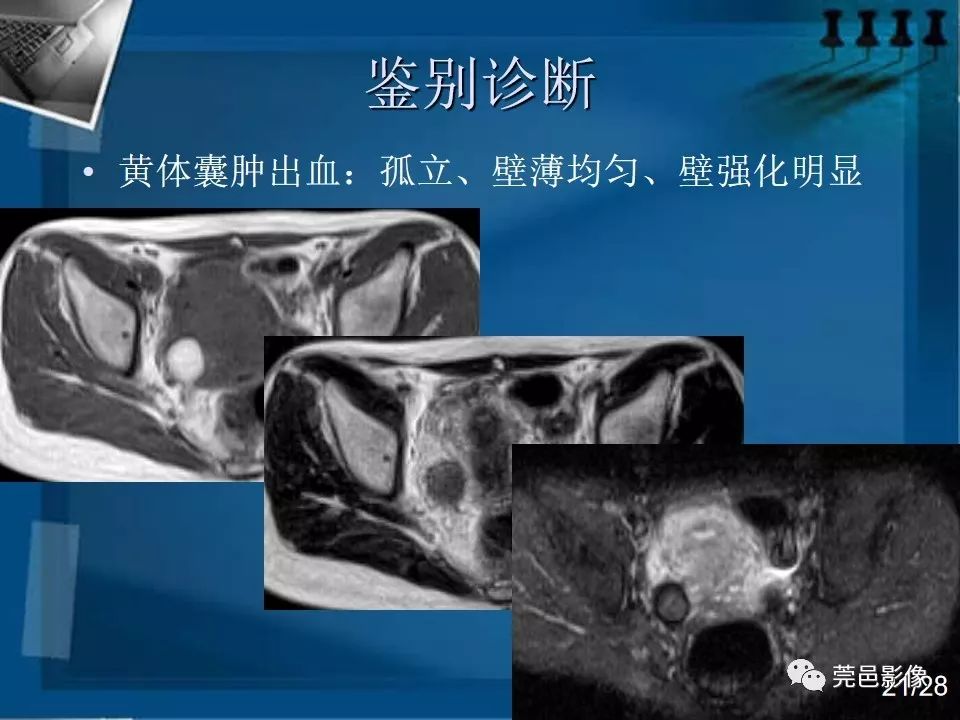 【PPT】子宫内膜异位症MRI诊断