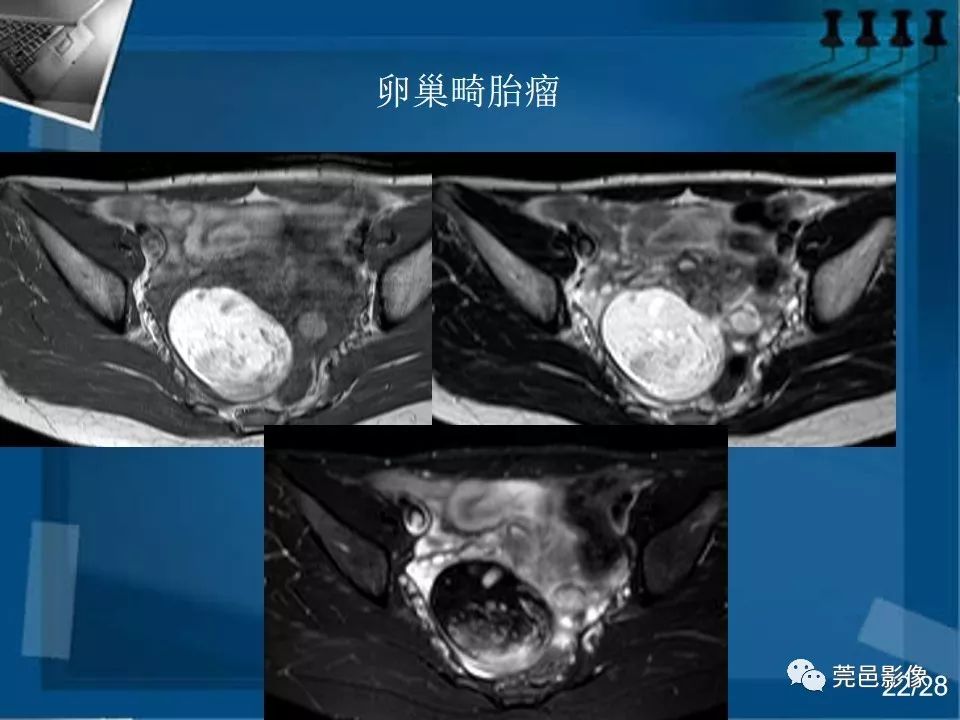 【PPT】子宫内膜异位症MRI诊断
