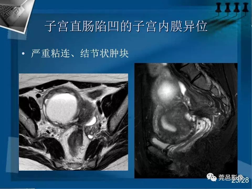 【PPT】子宫内膜异位症MRI诊断