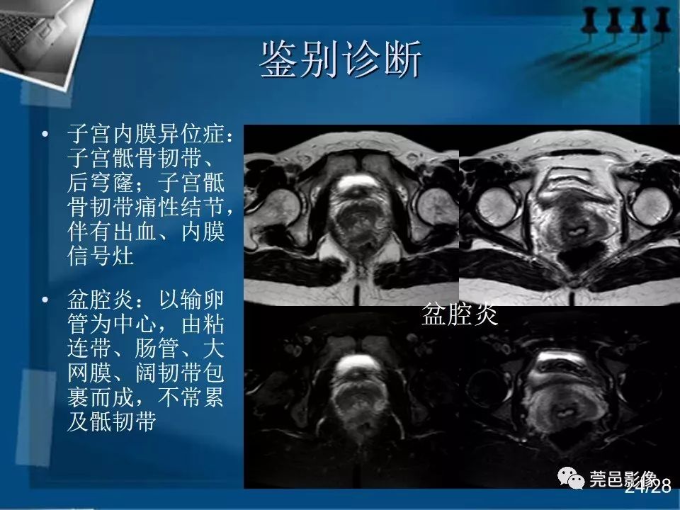 【PPT】子宫内膜异位症MRI诊断