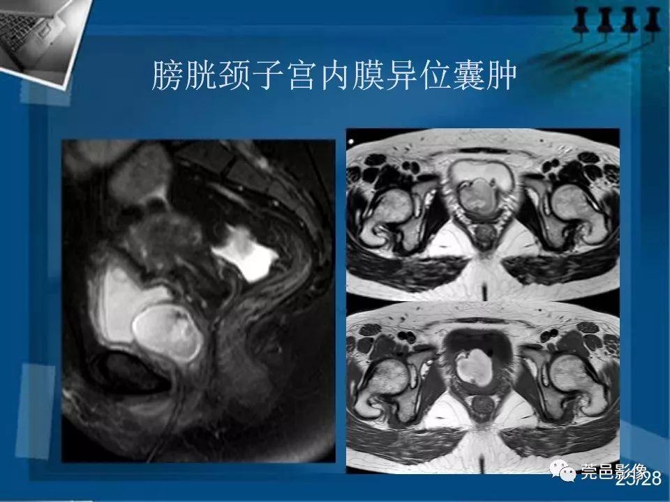 【PPT】子宫内膜异位症MRI诊断