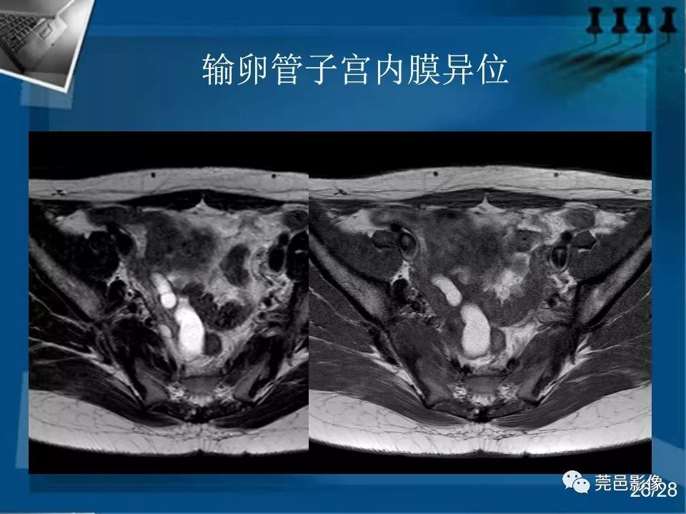 【PPT】子宫内膜异位症MRI诊断