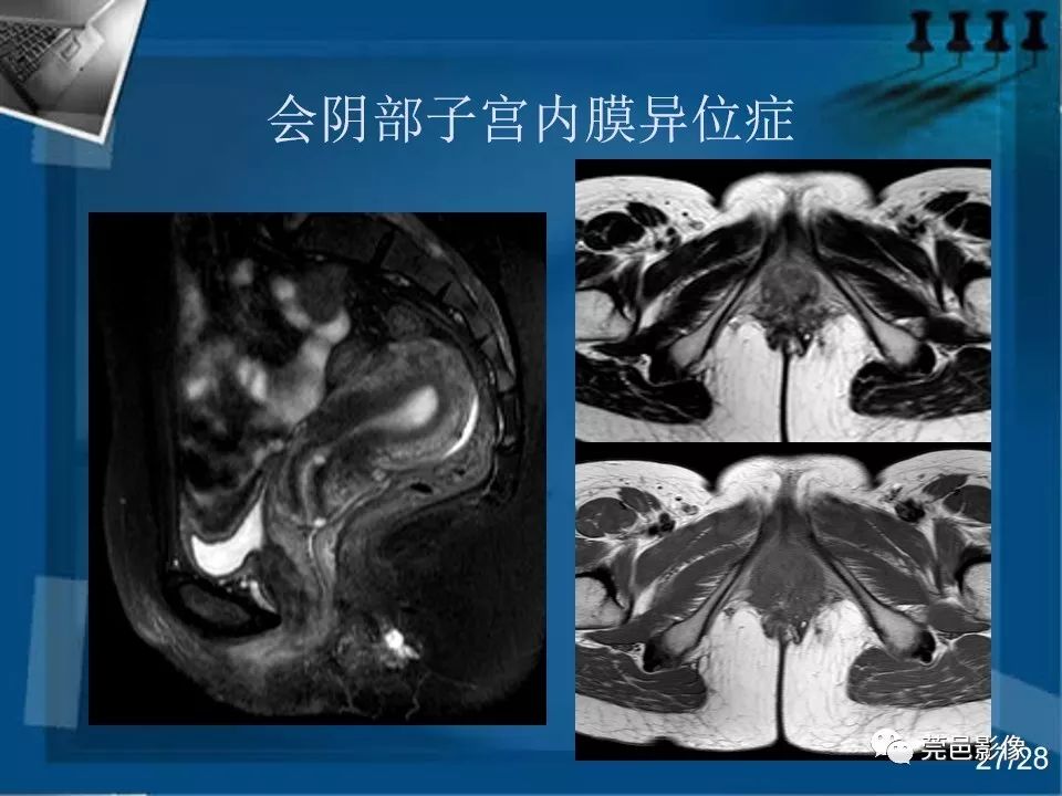 【PPT】子宫内膜异位症MRI诊断