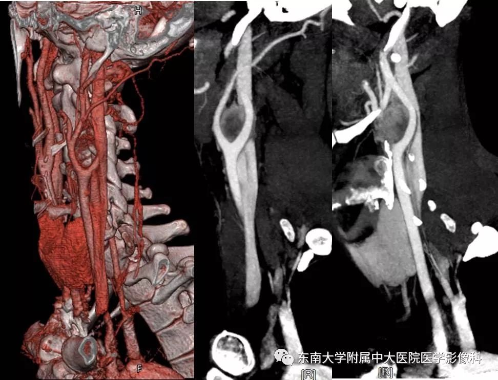 【PPT】颈动脉体瘤的影像