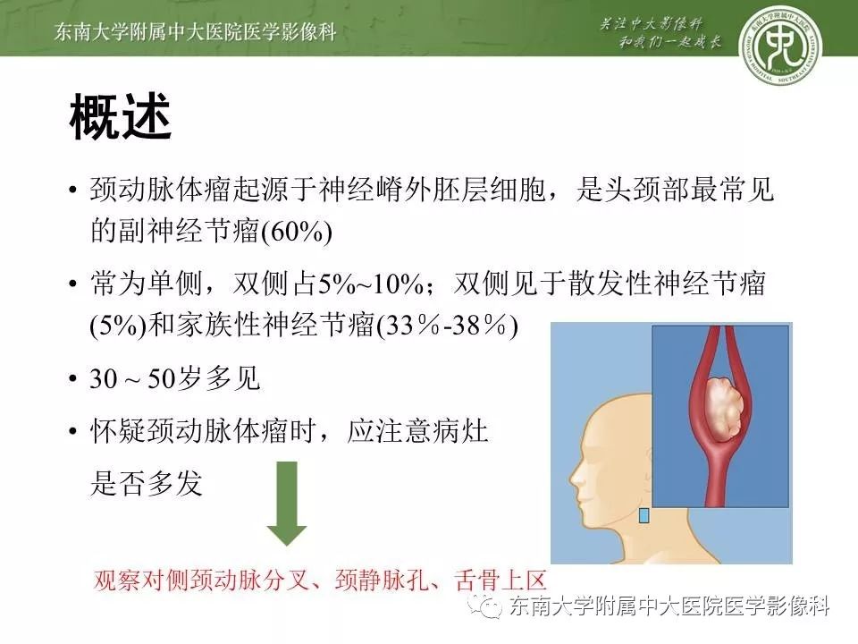 【PPT】颈动脉体瘤的影像