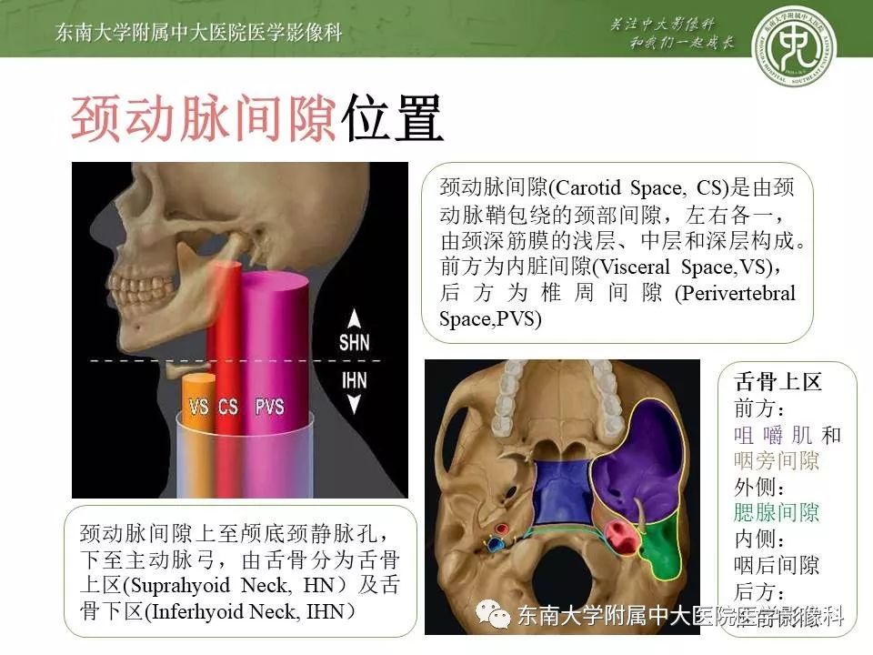 【PPT】颈动脉体瘤的影像