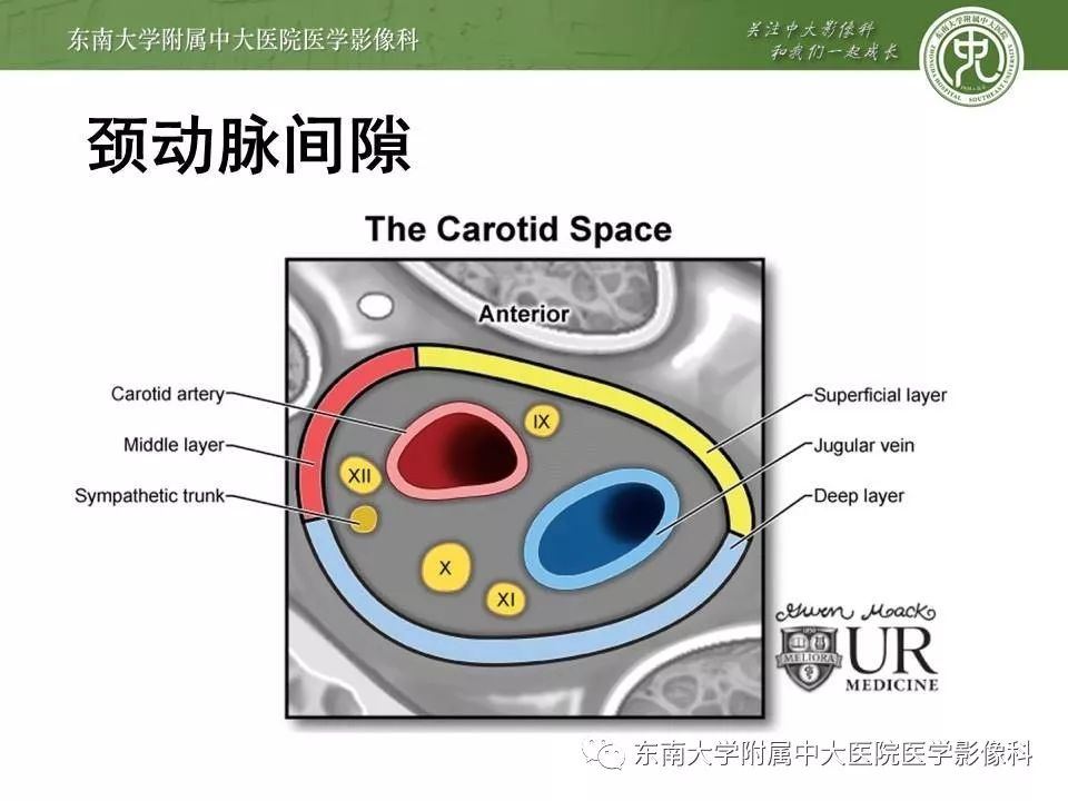 【PPT】颈动脉体瘤的影像