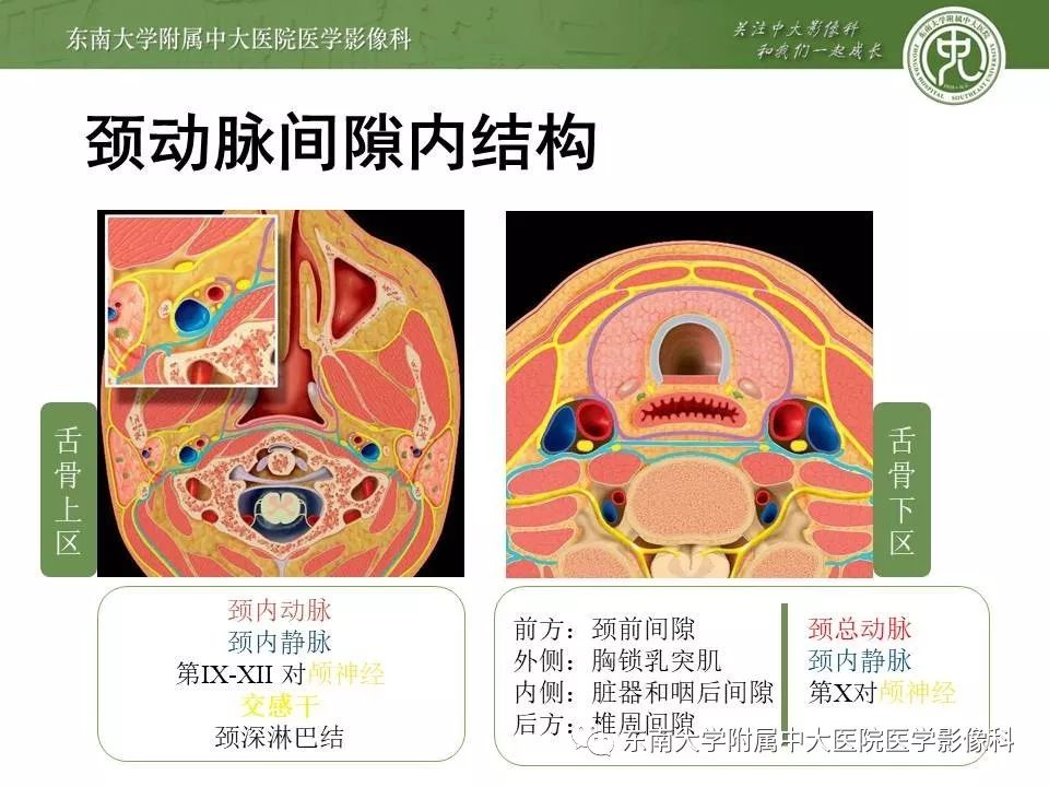 【PPT】颈动脉体瘤的影像