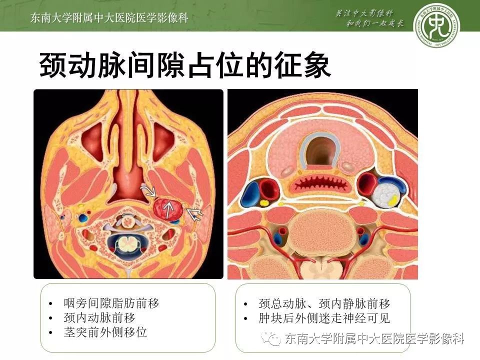 【PPT】颈动脉体瘤的影像