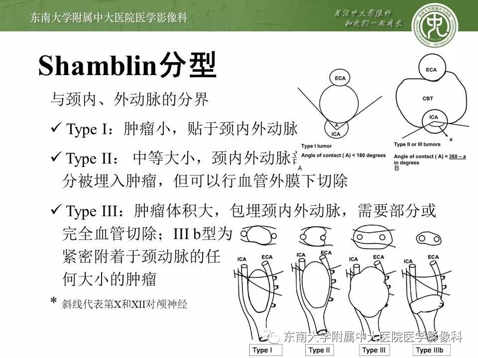 【PPT】颈动脉体瘤的影像