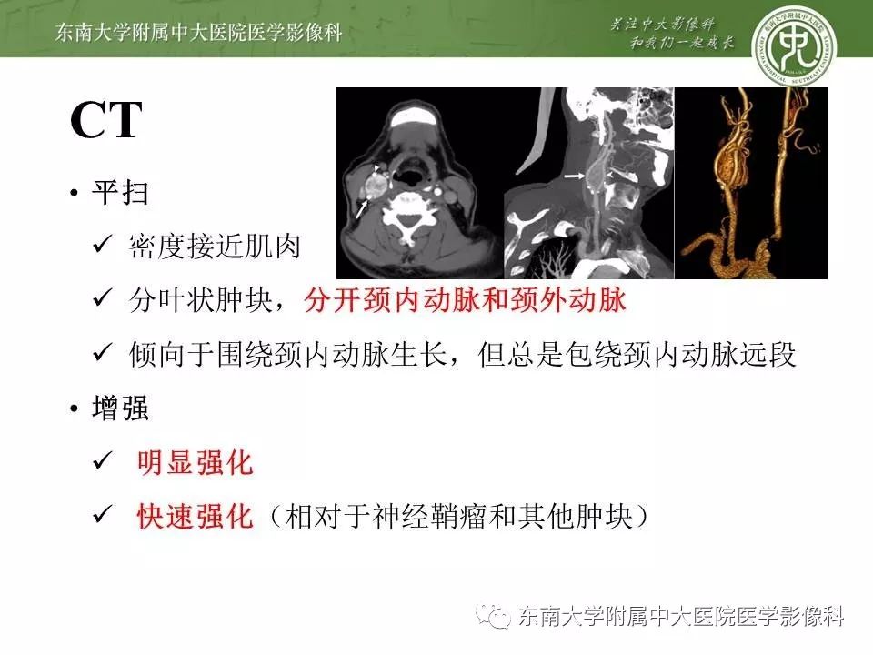 【PPT】颈动脉体瘤的影像