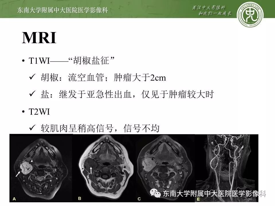 【PPT】颈动脉体瘤的影像