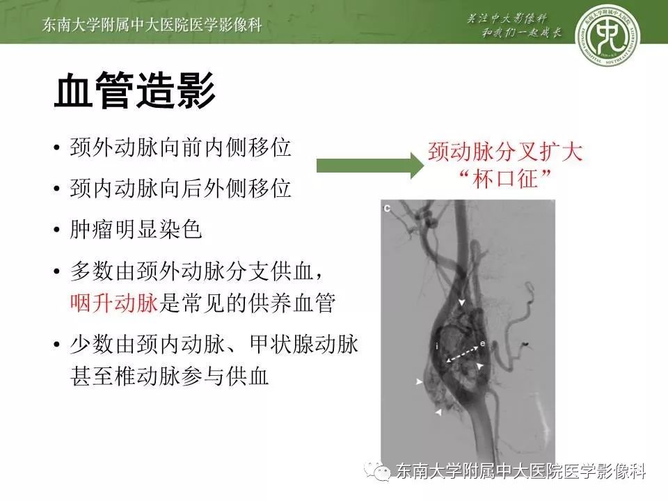 【PPT】颈动脉体瘤的影像