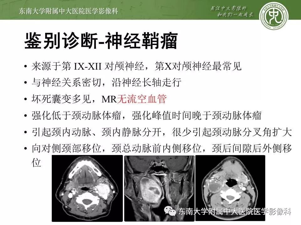 【PPT】颈动脉体瘤的影像