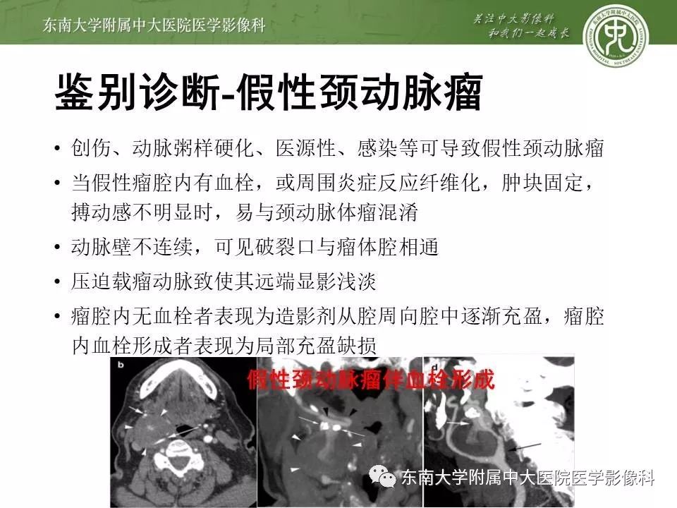【PPT】颈动脉体瘤的影像