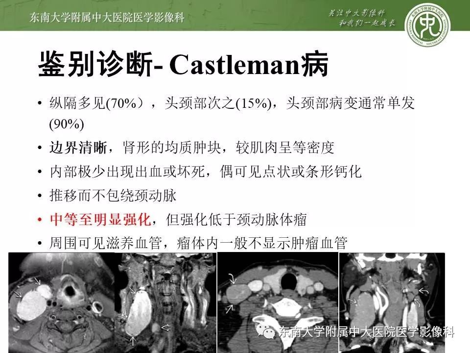 【PPT】颈动脉体瘤的影像