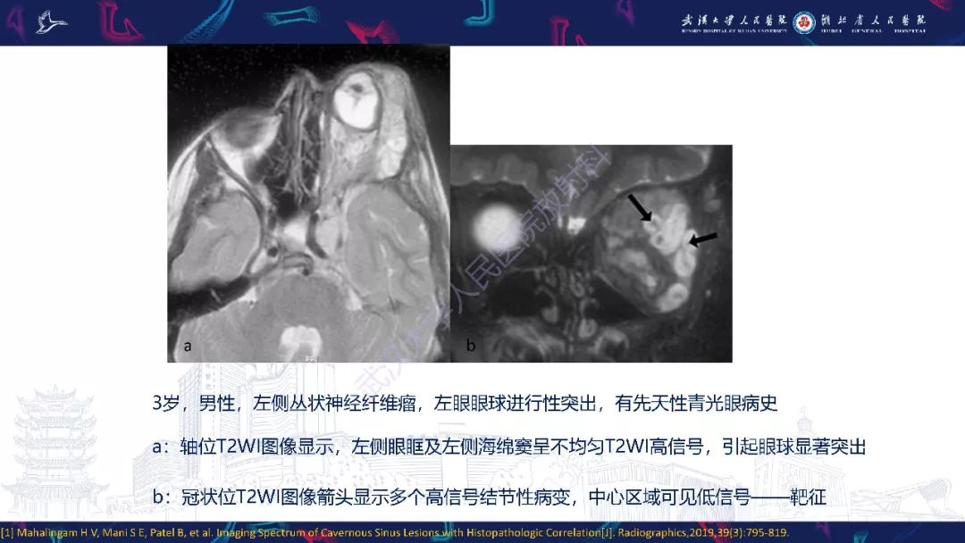 【PPT】三叉神经丛状神经纤维瘤影像诊断
