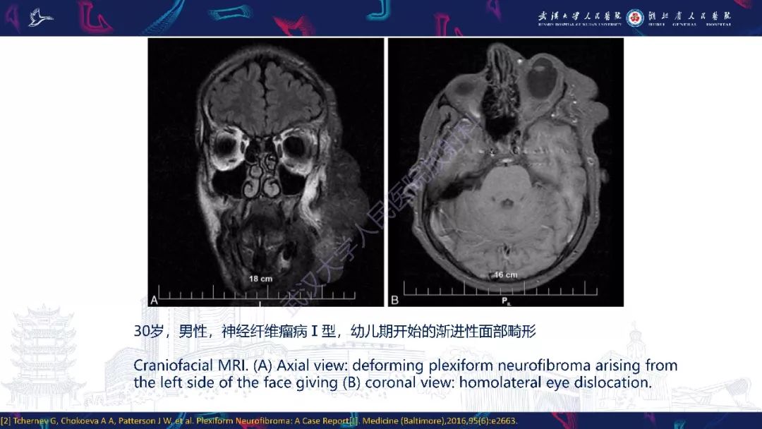 【PPT】三叉神经丛状神经纤维瘤影像诊断