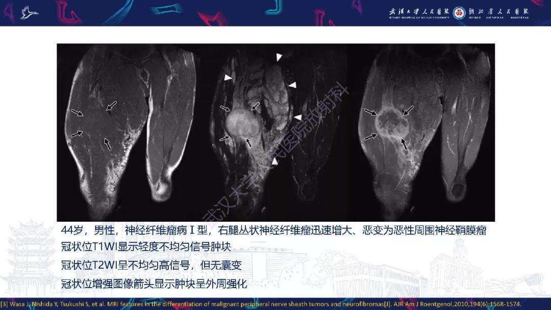 【PPT】三叉神经丛状神经纤维瘤影像诊断