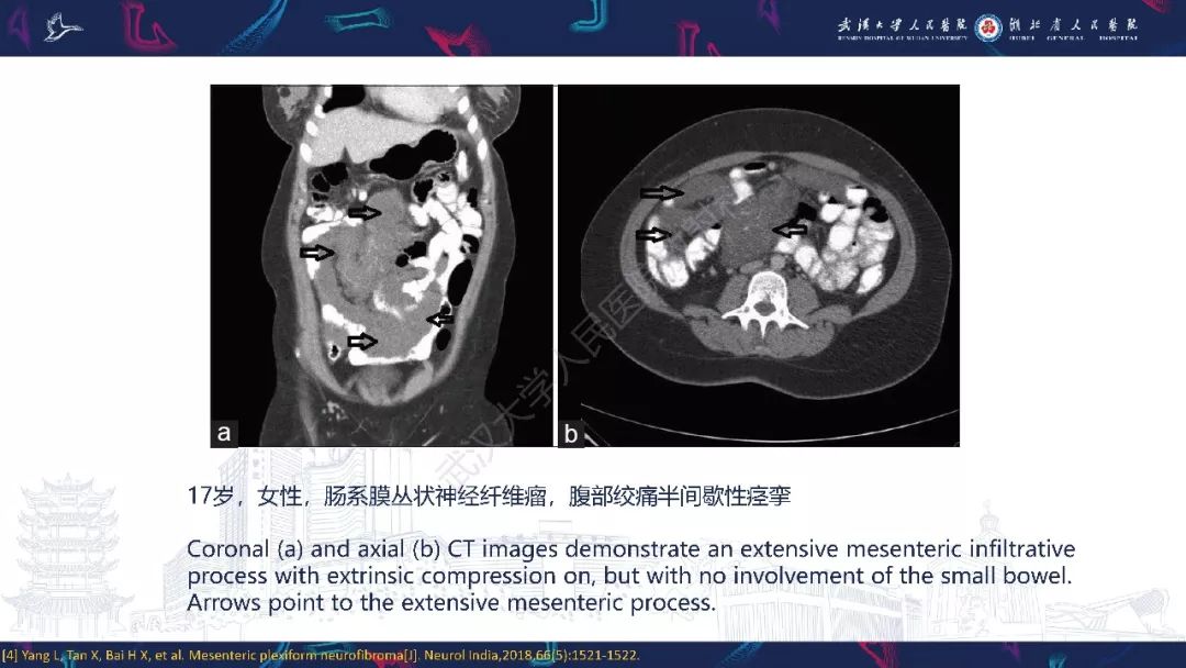 【PPT】三叉神经丛状神经纤维瘤影像诊断