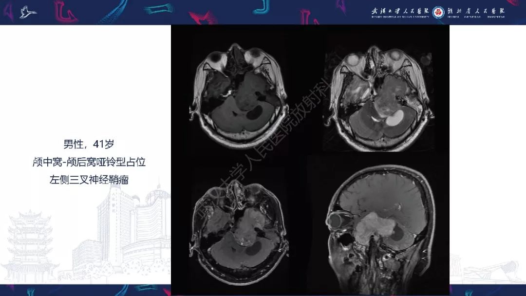 【PPT】三叉神经丛状神经纤维瘤影像诊断