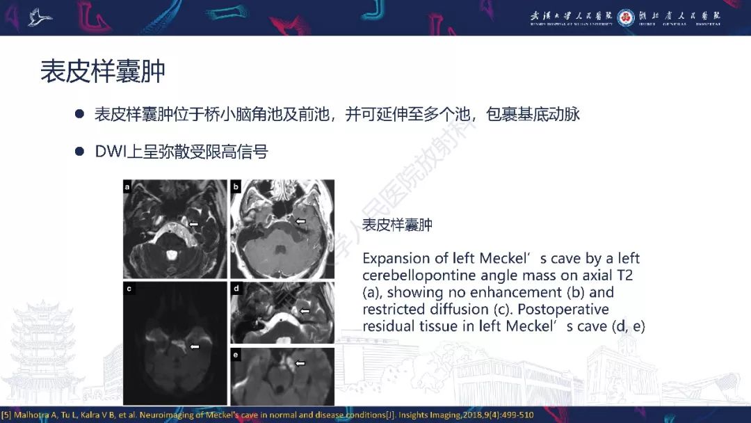 【PPT】三叉神经丛状神经纤维瘤影像诊断