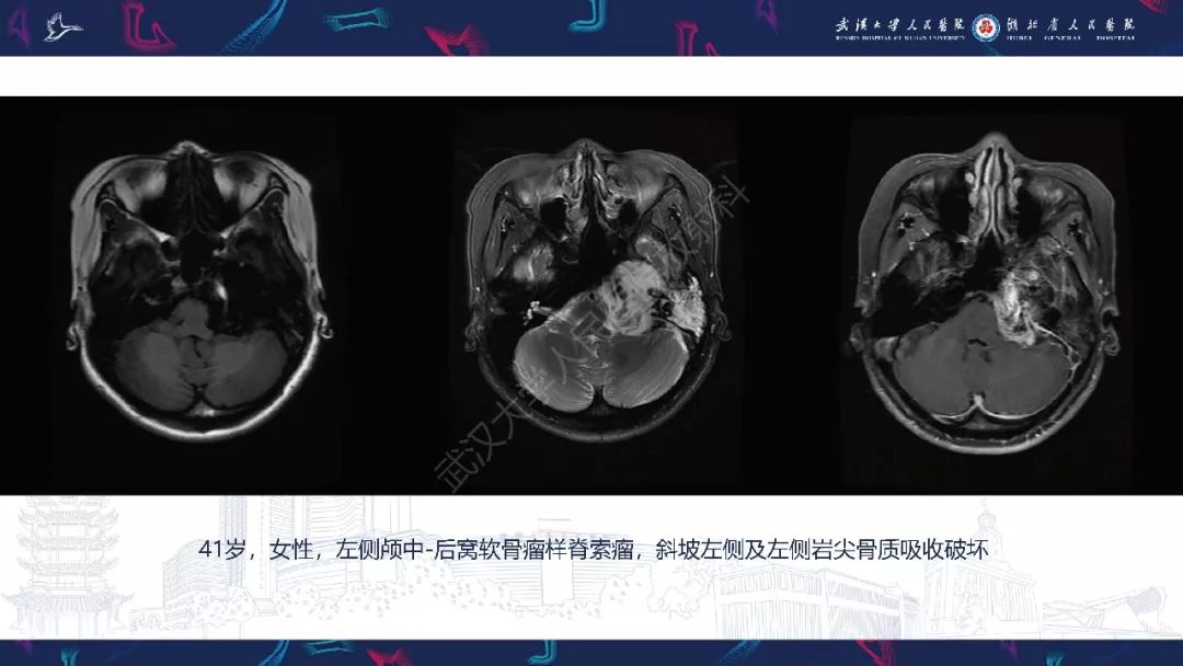 【PPT】三叉神经丛状神经纤维瘤影像诊断
