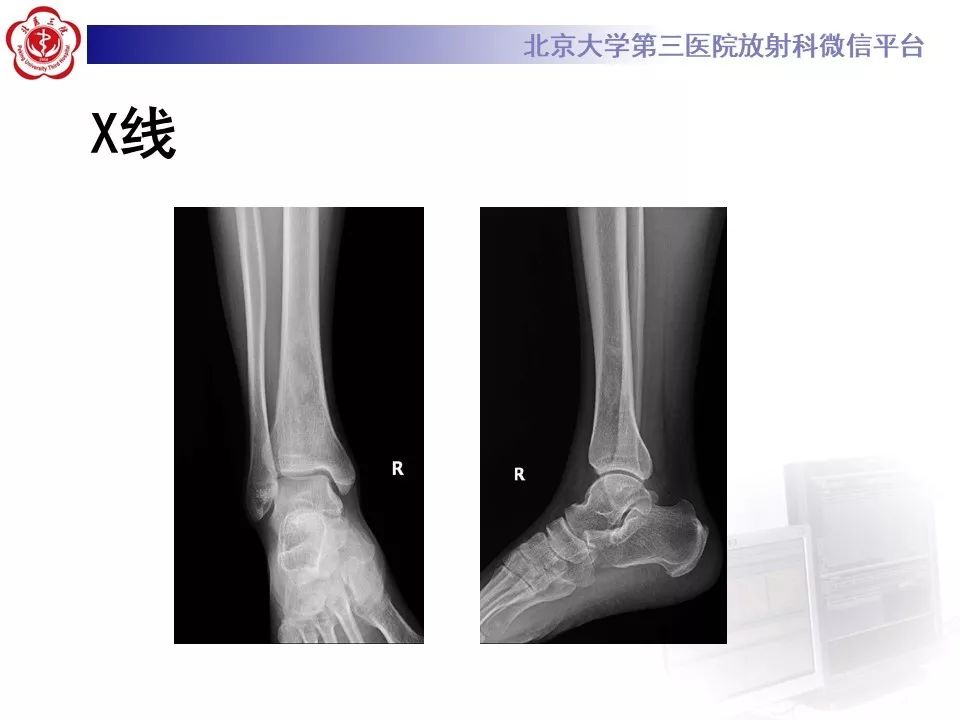 【PPT】ERDHEIM-CHESTER病的影像