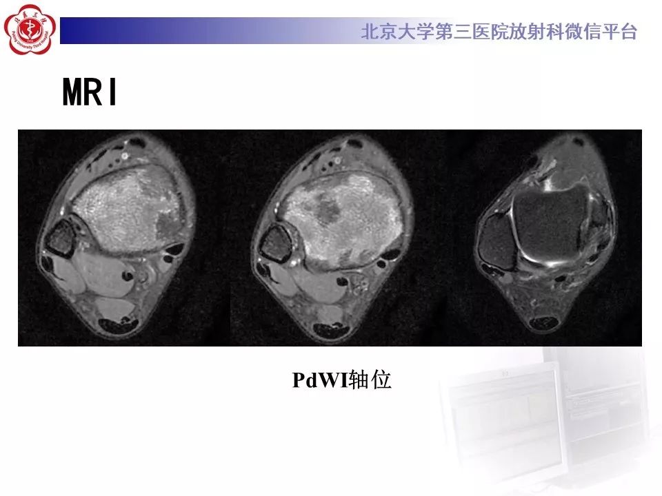【PPT】ERDHEIM-CHESTER病的影像